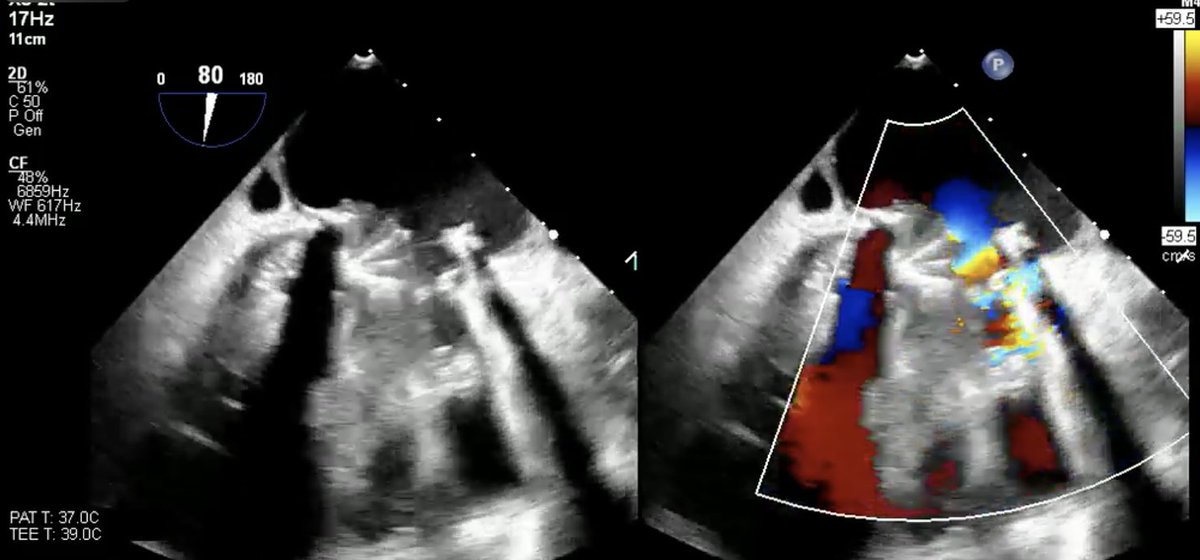 Case from our CardioOB clinic of🤰woman with mechanical mitral thrombosis causing cardiogenic shock is now out @JACCJournals Such amazing management from 🌟@hopkinsheart @hopkinsCTs @HopkinsGynOb fellows!! jacc.org/doi/10.1016/j.…