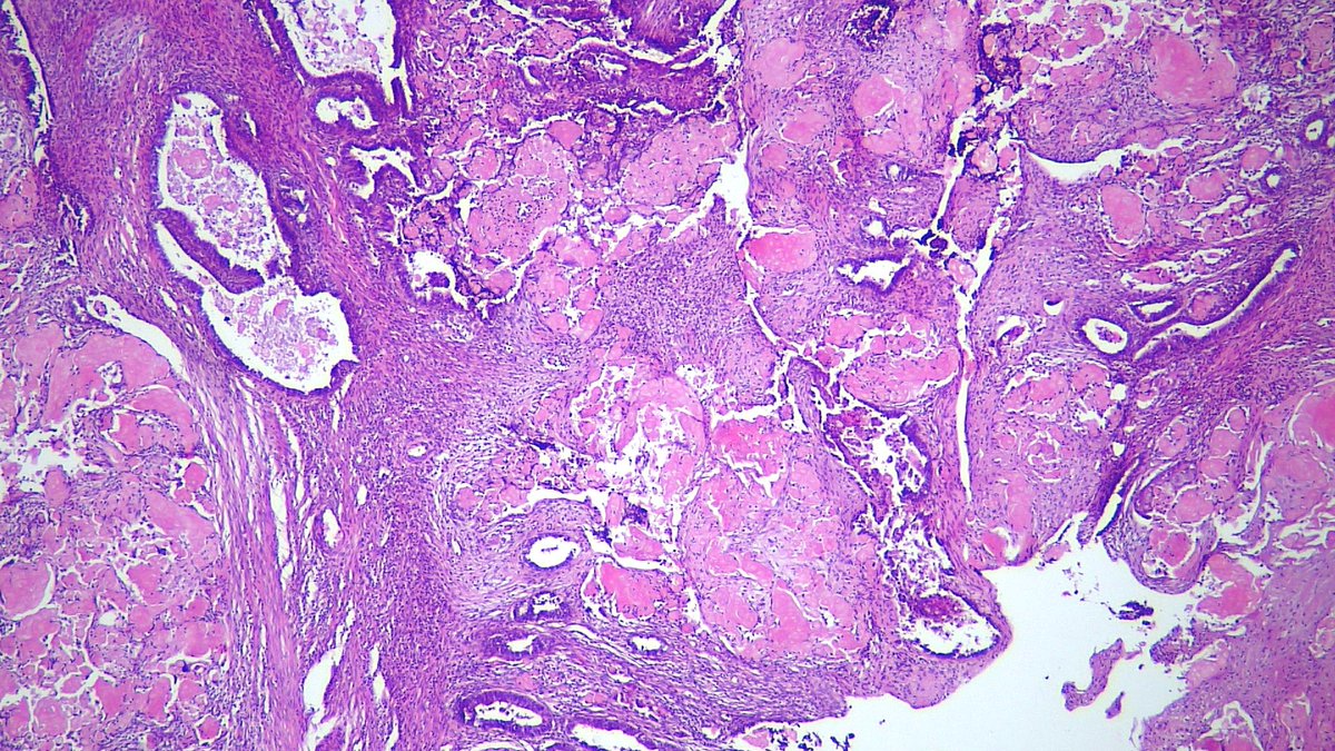 #Gynpath recurrent ovarian endometrioid carcinoma infiltrating the intestinal wall showing pilomatrixoma -like changes..