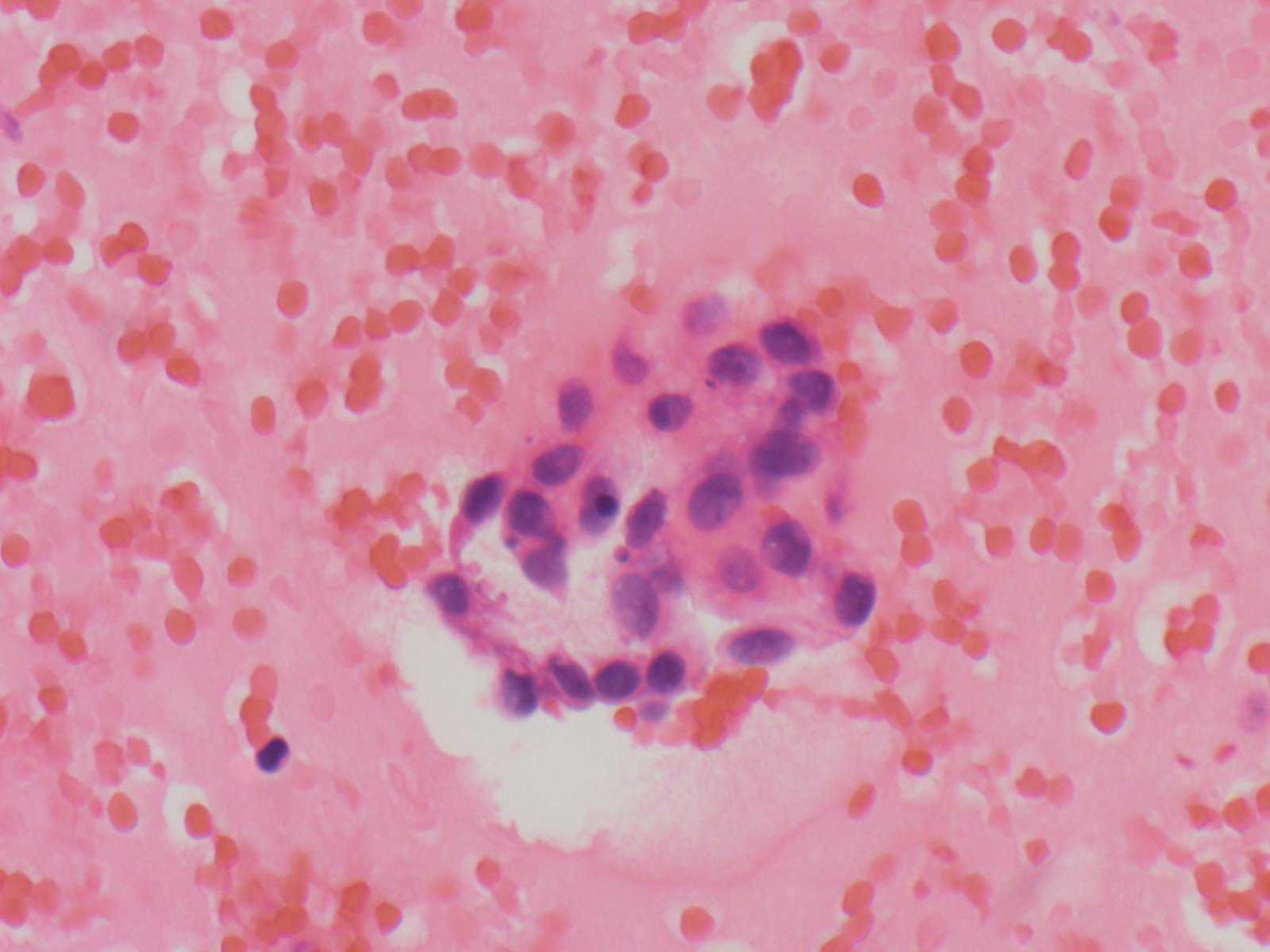 #UABCyto case by Dr. Caroline Stanek: 60 y/o F. Pleural effusion. Clusters of mildly atypical cells w/out classic features of macrophages/mesothelial cells. Rare intranuclear inclusions in CB. MOC31, BerEp4, Calretinin, TTF-1, and Pax8 positive, c/w metastatic thyroid carcinoma.