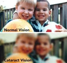 I am worse than the bottom pic in one eye. The second eye might be there by the time my left eye gets fixed 🤷🏻‍♂️😂😂😂