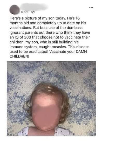 VoicesUnheard's tweet photo. MMR AND MEASLES! 

MMR Adverse reactions from MMR insert include as follows: 

💉 Panniculitis 
💉 Atypical Measles 
💉 Fever 
💉 Syncope 
💉 Headache 
💉 Dizziness 
💉 Malaise 
💉 Irritability 
💉 Vasculitis 
💉 Pancreatitis 
💉 Diarrhea 
💉 Vomiting 
💉 Parotitis 
💉 Nausea 
💉 Diabetes Mellitus 
💉 Thrombocytopenia
💉 Purpura 
💉 Regional Lymphadenopathy 
💉 Leukocytosis 
💉 Anaphylaxis 
💉 Anaphylactoid 
💉 Angioneurtic Edema (including facial and peripheral) 
💉 bronchial spasms in individuals with or without an allergic history 
💉 Arthritis 
💉 Arthralgia 
💉 Myalgia (Arthralgia and/or arthritis (usually transient and rarely chronic)
💉 Polyneuritis
💉 Encephalitis 
💉 Encephalopathy
💉 Measles inclusion body encephalitis (MIBE)
💉 Subacute sclerosing panencephelitis (SSPE) 
💉 Guillan-Barré Syndrome (GBS) 
💉 Convulsions or seizures 
💉 Ataxia
💉 Polyneuritis
💉 Polyneuropathy
💉 Oscular Palsies
💉 Parasthesia
💉 Aspetic Meningitis 
💉 Pnemonia
💉 Sore Throat 
💉 Cough 
💉 Rhinitis
💉 Steven Johnson Syndrome 
💉 Erythema multiforme
💉 Urticaria 
💉 Rash
💉 Measles like rash 
💉 Pruritis
💉 Burning stinging at injection site
💉 Wheal and flare
💉 Redness
💉 Swelling 
💉 Induration 
💉 Tenderness 
💉 Vesicularion at injection site 
💉 Henoch-Schönlein Purpura 
💉 Acute hemorrhagic edema in infancy 
💉 Nerve deafness 
💉 Otitis Media 
💉 Retinitis 
💉 Optic neuritis 
💉 Papillitis 
💉 Retrobulbar neuritis 
💉 Conjunctivitis
💉 Epididymitis 
💉 Orchitis 
💉 Death 

💉 Has not been evaluated for mutagenic, carcinogenic, or potential to cause infertility. 

💉 Excipients in MMR II: Chick embryo cell culture, WI – 38 human diploid lung fibroblast, vitamins, Amino acid’s, fetal bovine serum, sucrose, glutamate, recombinant human albumin, neomycin, sorbitol, hydrolyzed gelatin, phosphate, sodium chloride 

MEASLES SIDE EFFECTS: 

🌡 Cough
🌡 Runny nose 
🌡 Eye irritation 
🌡 Fever 
🌡 Generalized rash on days 4-10 of illness 

In rare situations: 

🌡 Brain Damage 
🌡 Death 

In the modern era, it is rare to suffer permanent disability or death from the measles in the US. 

1900-1963: the mortality rate of measles dropped from 13.3 per 100,000 to .02 per 100,00 in the population, due to advancements of living conditions, nutrition, and health care. 

🔅A 98% decline. 

1963: RIGHT BEFORE the vaccine was introduced: 

✅ 1 in 10,000 (.01%) measles cases were fatal 
✅ 1 in 20,000 (.005%) measles cases resulted in measles encephalitis 
✅ 1 in 80,000 (.00125%) measles cases resulted in permanent disability 
✅ 7 in 1,000 (.7%) measles were hospitalized 

** LOW VITAMIN A is a primary cause of over 100,000 measles deaths in underdeveloped countries, especially those with wide spread poverty. 

***IN THE US 75-92% of hospitalized measles cases are low in vitamin A. 

The World Health Organization recommends that serious measles cases be treated with high-dose vitamins A, 50,000 IU- 200,000 IU, administered orally on two consecutive days. 

Are there ANY BENEFITS to the measles?? 

❇️ Studies suggest a natural acquired measles infection and a reduced risk of Hodgkin’s and Non-Hodgkins lymphomas as well as..
❇️ Reduced risk of atopic diseases such as eczema, hay fever, asthma. 
❇️ Lower risk of mortality from cardiovascular disease as adults 
❇️ Infants born to mothers who have had naturally acquired measles are protected from measles via maternal immunity longer than born to vaccinated mothers. 

Please see sources here: 

MMR Vaccine Insert: https://t.co/q32LLXk4bW

Studies showing the BENEFITS of getting measles (and mumps) 

Wild measles and mumps protects against heart problems. https://t.co/3vb0QAIaio 

Wild Mumps: Researchers investigated whether mumps might engender immunity to ovarian cancer through antibodies against the cancer-associated antigen MUC1 abnormally expressed in the inflamed parotid gland. 
https://t.co/5N5HfNq9SB