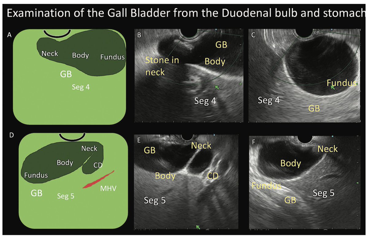Happy to share that our article on 'Linear EUS of the Biliary System examination and its Clinical application' got published in Journal of Digestive Endoscopy. Article is purely focussing on bile duct & GB examination. Kindly find this full text link. thieme-connect.com/products/ejour…