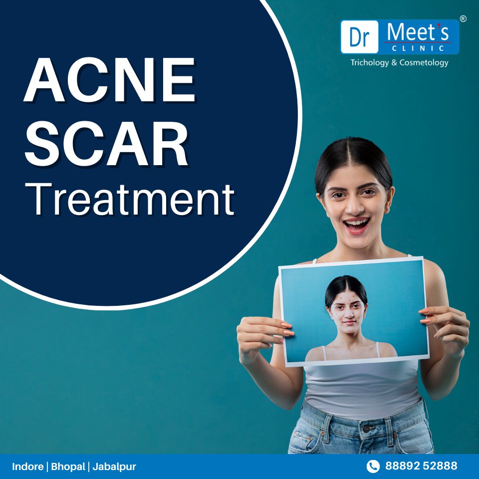 Book an appointment now for all your Acne related problems ✨
.
.
.
.
.
.
#acnetreatment #acnescartreatment #acnecare #acneproblems #acneremoval #acnefree #acnescars #drmeetsclinic #drmeet #bhopal #indore #consultnow #bookanappointmentnow #consultus