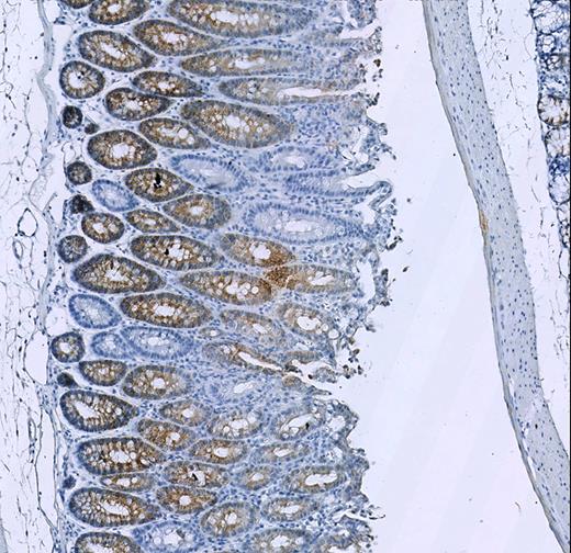 DMM_Journal's tweet photo. Day8⃣ of #12DaysofEdsChoice: @PathologyEdin & team unveiled how alcohol consumption increases the risk of colon cancer in #LynchSyndrome:
✨by David Church @HumanGeneticsOx
https://t.co/psR8G8Zzqi
📰
https://t.co/gk1ZaoVdwS https://t.co/X4rmnCJGsE