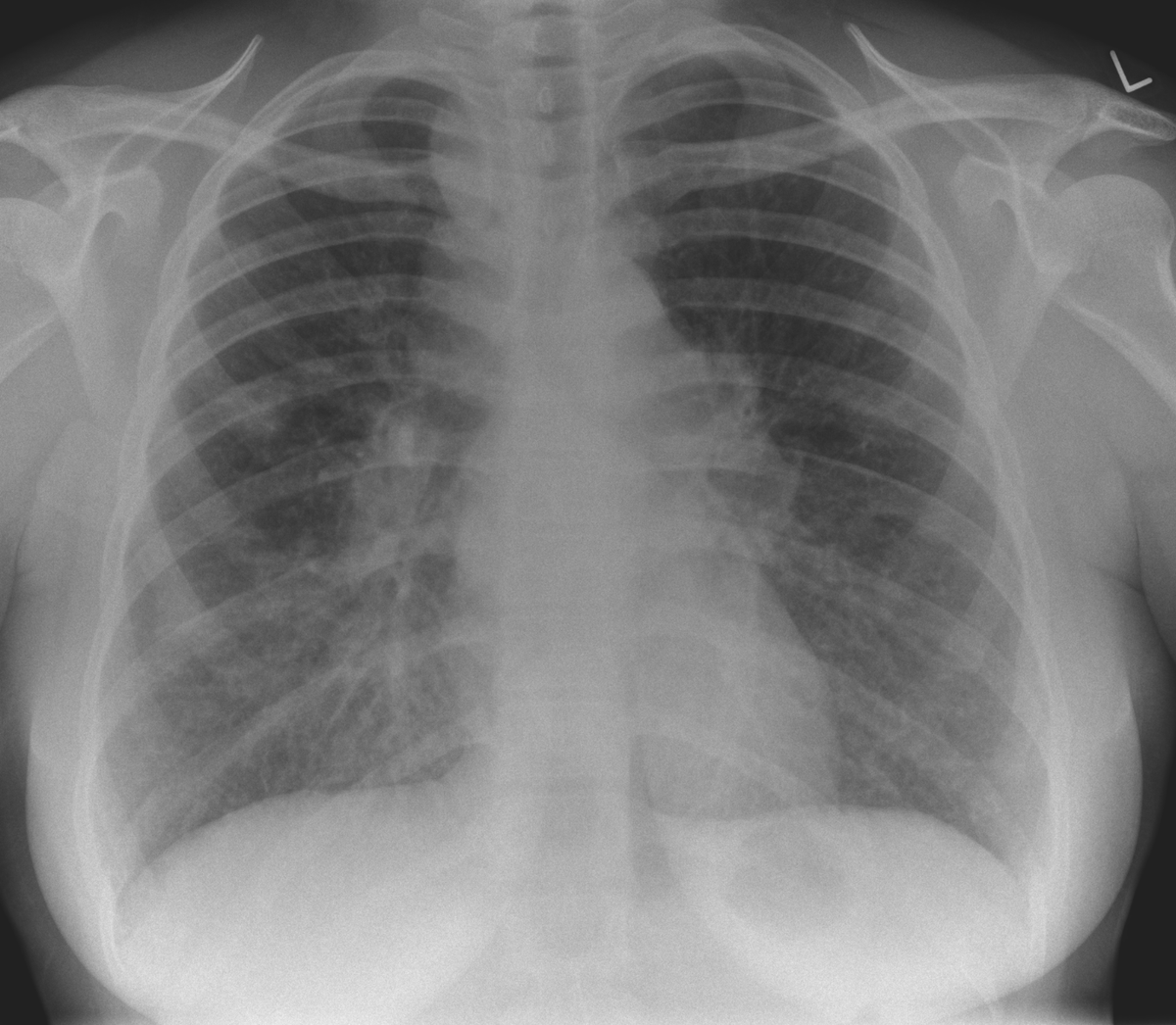 We have posted the answer to this week's radiology image challenge on the ERS Facebook. Head over to see if you got the answer correct: facebook.com/EuropeanRespir… Thanks for taking part! Try more case studies on the ERS Respiratory Channel: channel.ersnet.org/channel-52-rad… #ImageOfTheWeek