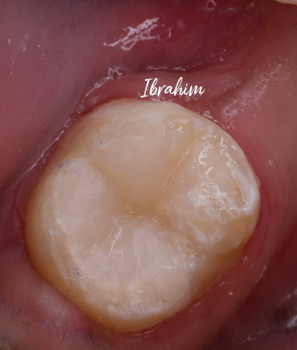#الخميس_الونيس خفايف الخميس ✨

#47 Cl I Composite restoratio