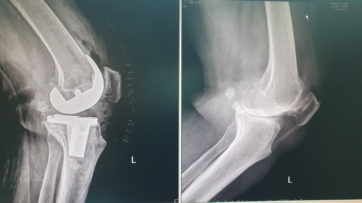surgeonfk's tweet photo. 🔊"ACL deficiency causes end-stage
knee decompensation with
‘cupula’ (aggressive wear) posteromedial tibial plateau". 🤔
This knee had intact ACL !! https://t.co/49hUNONp93