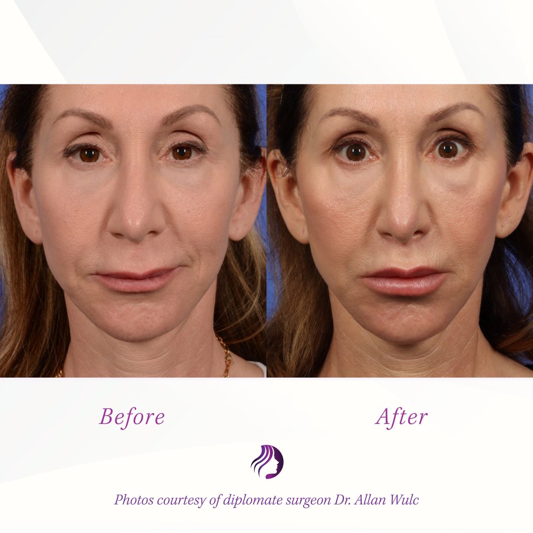 ABFCSorg's tweet photo. A #LipLift is a surgical procedure that shortens the space between the nose &amp; upper lip, increasing the amount of “lip show.”

These lip lift results are courtesy of diplomate @AllanWulcMD of W Cosmetic Surgery. https://t.co/G6hls5kvry