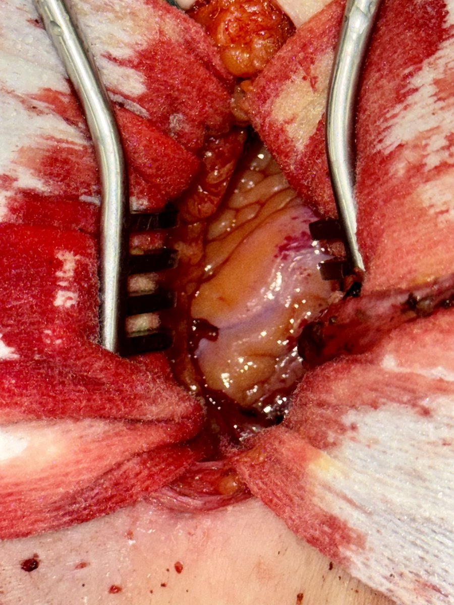 SaadHasanMD's tweet photo. It’s a good day when the LAD is right in the middle of your mini thoracotomy, begging to be bypassed. (With permission) @TCHheart #MIDCAB https://t.co/SkC2YKLuoH