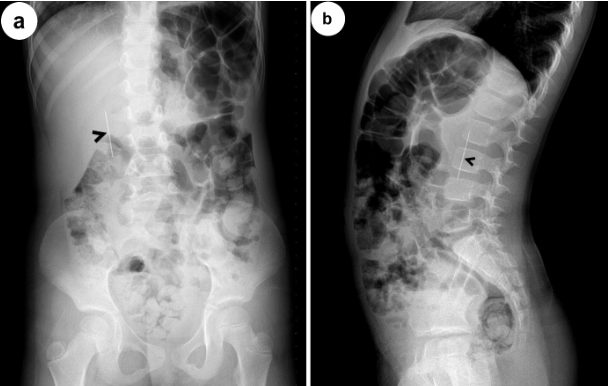 JPGNonline's tweet image. 4 yo who swallowed a needle three hours ago goes to the ED.  PE is unremarkable.  Xray obtained.  

Where is the ingested needle most likely based on the X-ray? 

Answer and learn more 👉 bit.ly/3htf9YP?utm_so…

#imageofthemonth #quickpoll