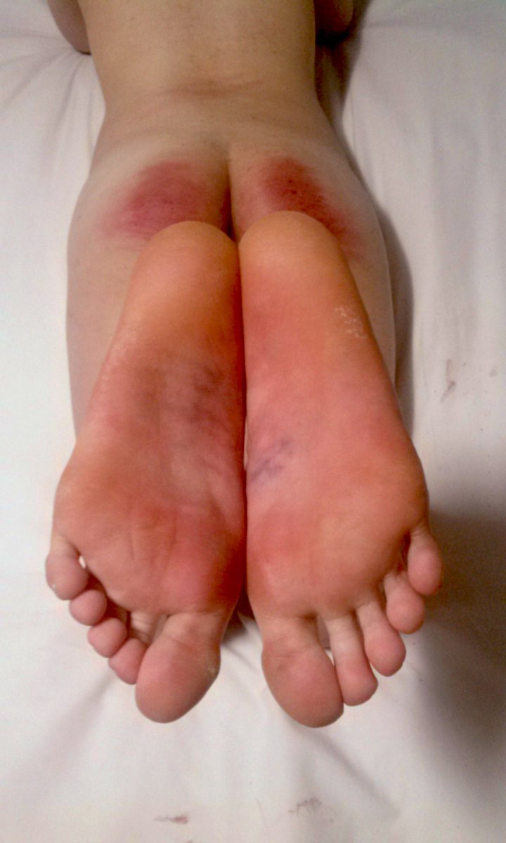 오래된 사진 발견 ... 이제는 왠만해선 멍들지 않는 발바닥 ..😅
#펨섭키 #멜돔커 #멀티플 #대구 #경북 #구인중