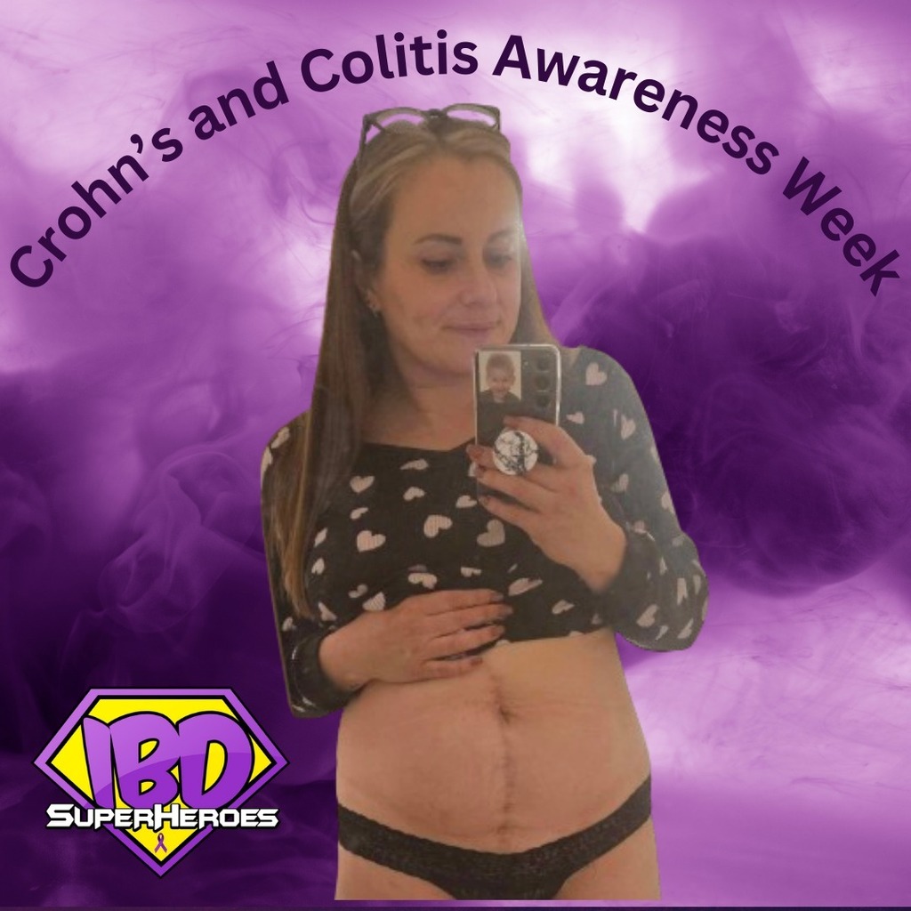#CrohnsAndColitisAwarenessWeek I had my large intestine removed over 20 years ago... I feel old 😩 Back then there were limited medical options to keep my #UlcerativeColitis under control, and I was young and struggled to keep on top of the medicati… instagr.am/p/C0jskVMuieN/