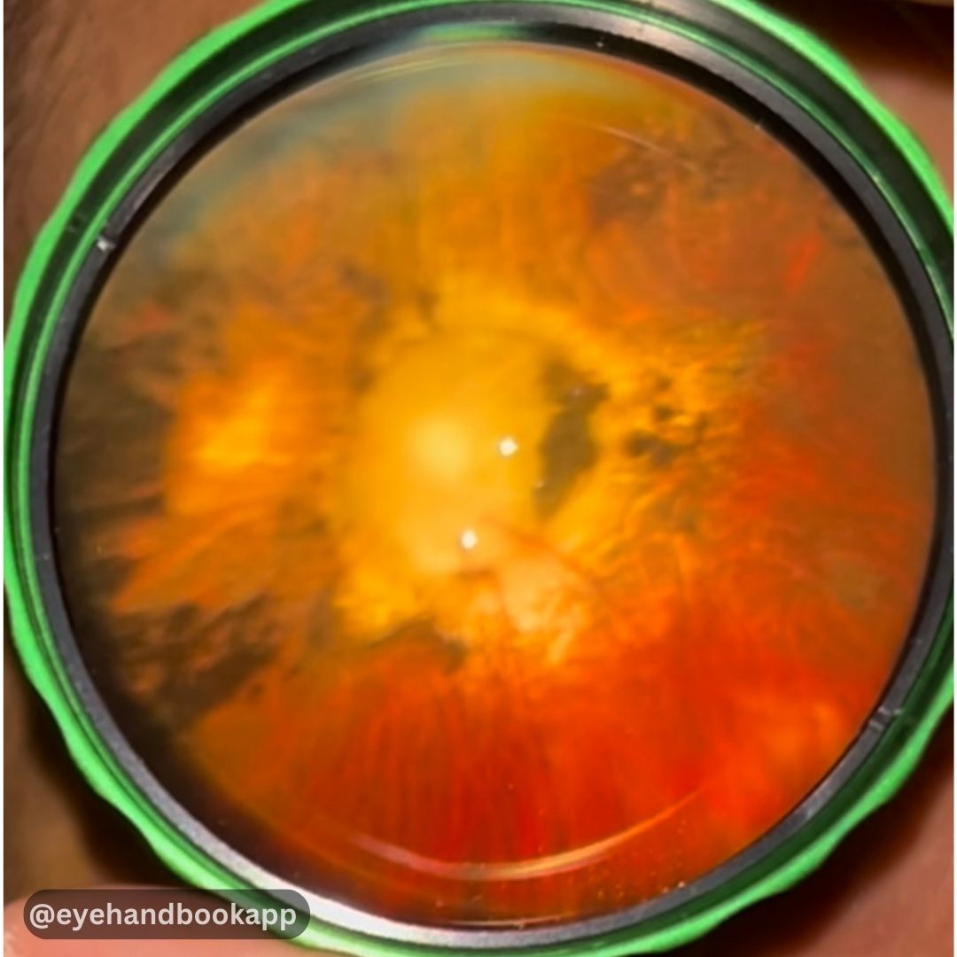 What is your diagnosis?

#eyes #diabeticretinopathy #diabeteseyecare #diabeteseyedisease #clinicalcalculators #eyecalculators #ophthalmologist #optometrist #eyedoctors #ophthalmology #optometry #oftalmologia #free #vision #slitlamp #visiontesting #EyeCare #diabetes #diabetic