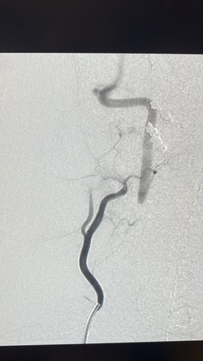 Cervical soft tissue pre-op embo. Sobering reminder to watch out for EC-IC collaterals! Pre and post. No visualized vertebral opacification during blank roadmap embo. <a href="/UCSF_NIR/">UCSF Neuroendovascular Surgery</a> <a href="/YNIScommittee/">YNIS Committee</a> <a href="/EricRSmithMD/">Eric R Smith</a>