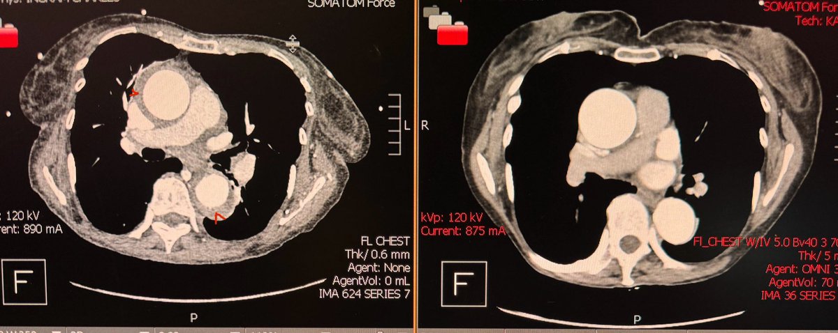 sharma3akanksha's tweet image. Not all life threatening conditions are ‘type A’. Here is the CT chest with contrast of a 82 yo woman presenting with chest pain and abdominal pain. Can you guess the diagnosis? #cardiovascularimaging #LearnAndGrow