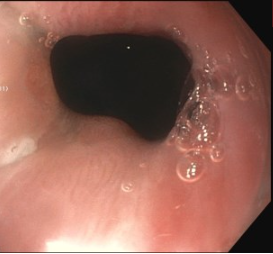 Erik Holzwanger, MD, ABOM-D (@hilarholzy) on Twitter photo Per oral endoscopic myotomy (POEM) is a life altering procedure for patients with achalasia
Excited to share the continued growth of our endoluminal surgery program <a href="/TuftsMedicalCtr/">Tufts Medical Center</a> with the first esophageal POEM done
👀 GEJ before and after below
#GITwitter #MedEd Per oral endoscopic myotomy (POEM) is a life altering procedure for patients with achalasia
Excited to share the continued growth of our endoluminal surgery program <a href="/TuftsMedicalCtr/">Tufts Medical Center</a> with the first esophageal POEM done
👀 GEJ before and after below
#GITwitter #MedEd