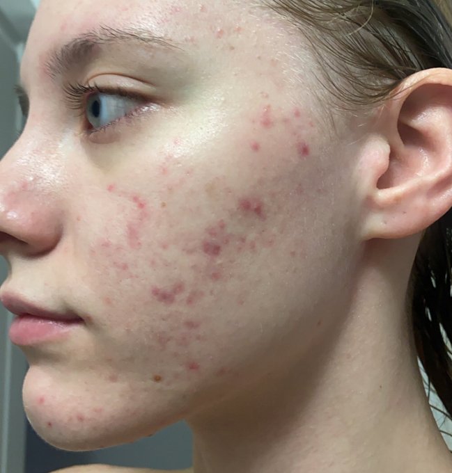 This is just one side of my face, and look at how much better it&rsquo;s gotten over the years🥹🫶🏻 i still have