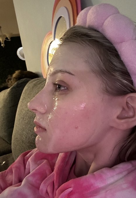 This is just one side of my face, and look at how much better it&rsquo;s gotten over the years🥹🫶🏻 i still have