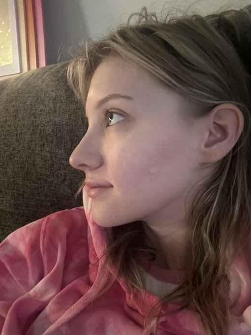 This is just one side of my face, and look at how much better it&rsquo;s gotten over the years🥹🫶🏻 i still have