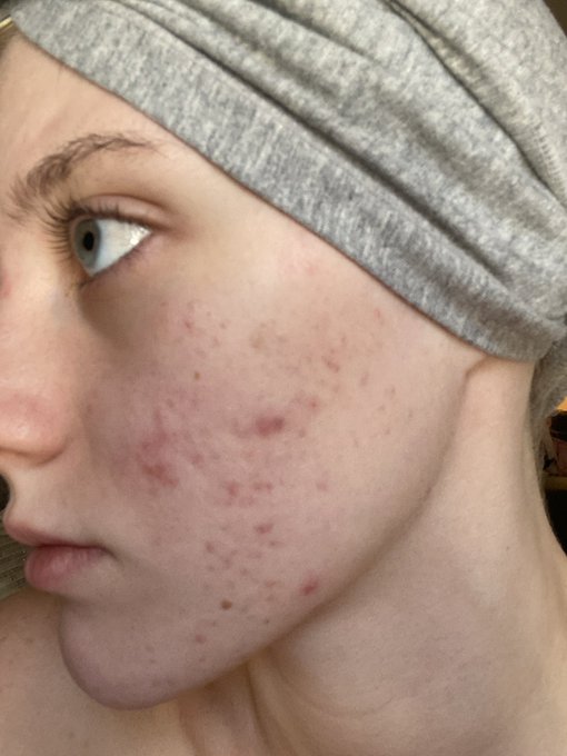 This is just one side of my face, and look at how much better it&rsquo;s gotten over the years🥹🫶🏻 i still have