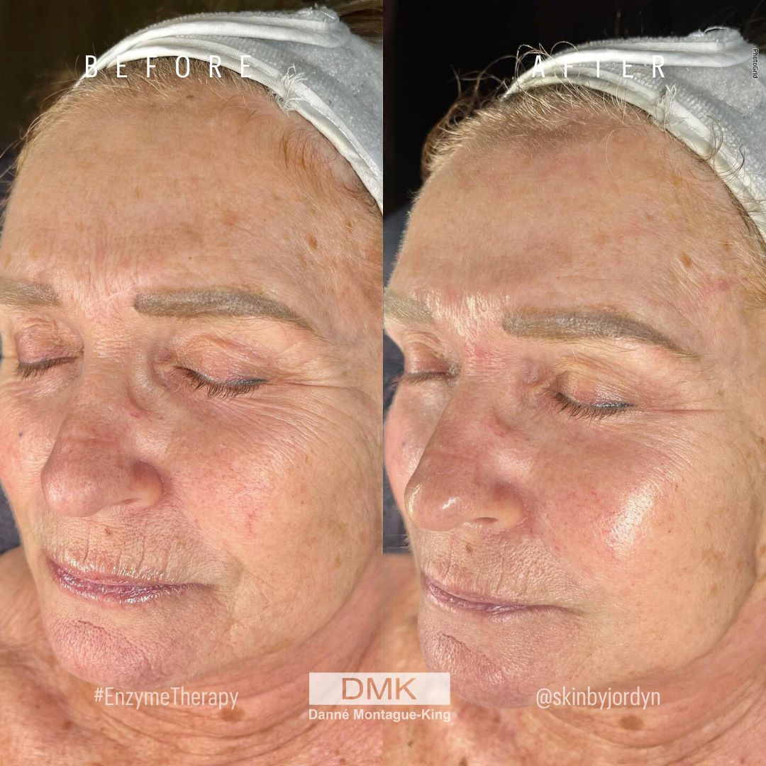 DMKIntlHQ's tweet image. Can you guess how many DMK Muscle Banding treatments went into achieving these results? ⁠
⁠
A.) 1 
B.) 2 
C.) 3 

This incredible result was achieved by 📸@skinbyjordyn
⁠
#SkinCondition #SkinTreatment #BeforeAndAfter #DiscoverDMK #DMKEnzyme #DMKInternational