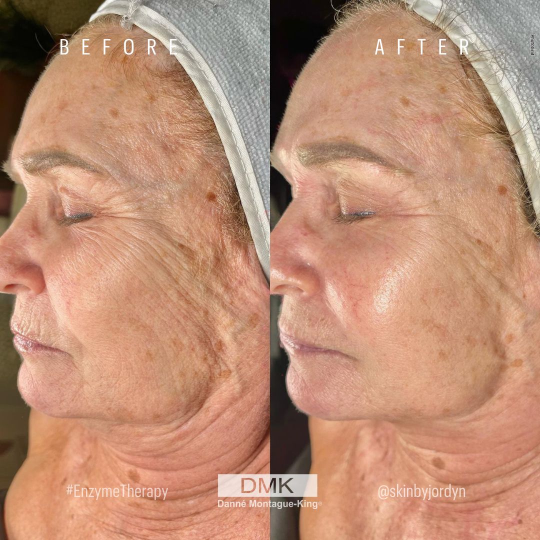 DMKIntlHQ's tweet image. Can you guess how many DMK Muscle Banding treatments went into achieving these results? ⁠
⁠
A.) 1 
B.) 2 
C.) 3 

This incredible result was achieved by 📸@skinbyjordyn
⁠
#SkinCondition #SkinTreatment #BeforeAndAfter #DiscoverDMK #DMKEnzyme #DMKInternational