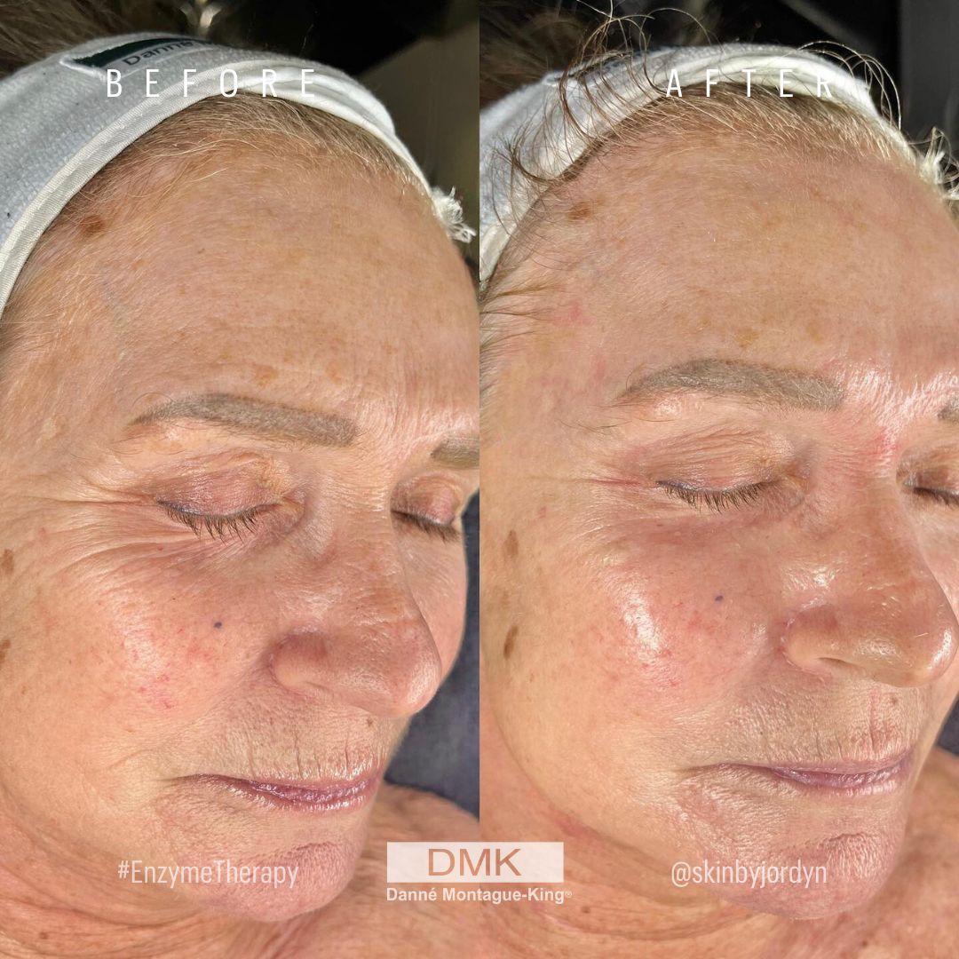 DMKIntlHQ's tweet image. Can you guess how many DMK Muscle Banding treatments went into achieving these results? ⁠
⁠
A.) 1 
B.) 2 
C.) 3 

This incredible result was achieved by 📸@skinbyjordyn
⁠
#SkinCondition #SkinTreatment #BeforeAndAfter #DiscoverDMK #DMKEnzyme #DMKInternational