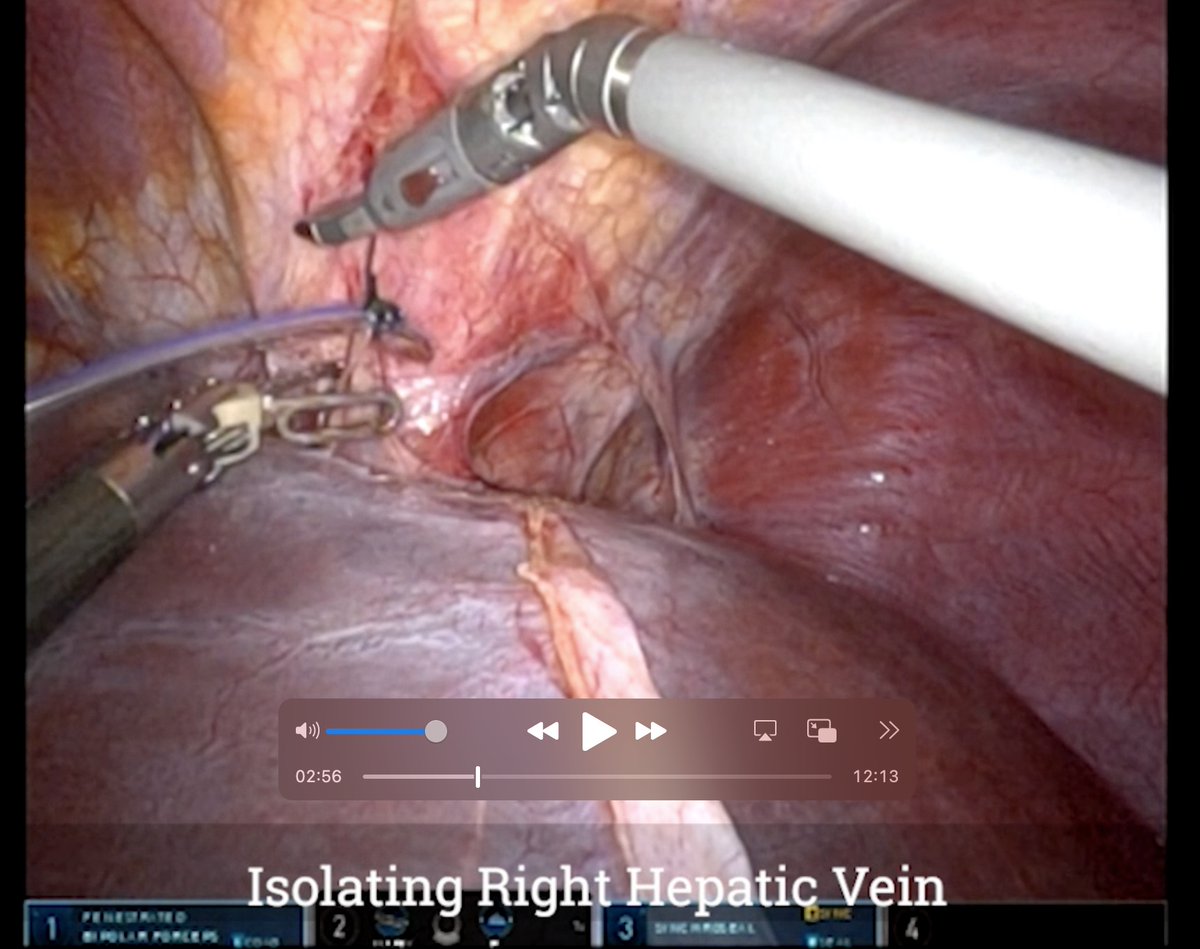 Ben Samstein (@bensamstein) on Twitter photo Robotic Right Donor Hepatectomy for LDLTL
12min <a href="/JHawksworthMD/">Jason Hawksworth MD, FACS</a> <a href="/juampirocca/">Juan Pablo Rocca</a> <a href="/rrosenblattmd/">Russell Rosenblatt</a> <a href="/IswantoSucandy/">Iswanto Sucandy MD</a>
youtu.be/kxnRzSKdgyg?si… via <a href="/YouTube/">YouTube</a> Robotic Right Donor Hepatectomy for LDLTL
12min <a href="/JHawksworthMD/">Jason Hawksworth MD, FACS</a> <a href="/juampirocca/">Juan Pablo Rocca</a> <a href="/rrosenblattmd/">Russell Rosenblatt</a> <a href="/IswantoSucandy/">Iswanto Sucandy MD</a>
youtu.be/kxnRzSKdgyg?si… via <a href="/YouTube/">YouTube</a>