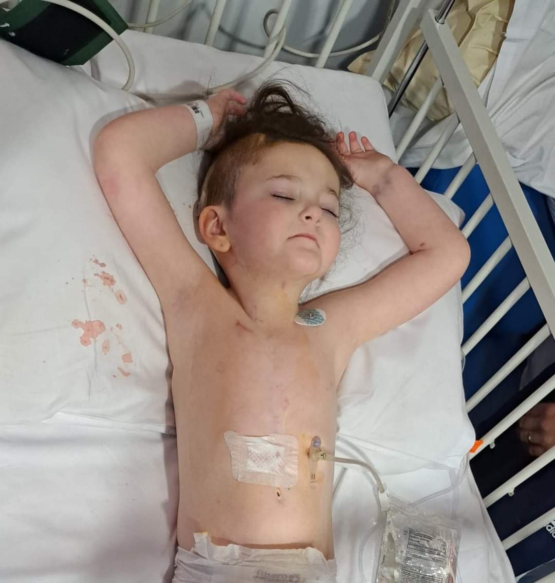 myahsjourney's tweet photo. And it's all over her. Head opened, stomach opened 🙈, but surgery was a success 🙏  back recovering on the ward.  Thankyou again everyone 💓 #recoverystartsnow #shuntlife #hydrocephalus 💖💖 https://t.co/p5EQB3d2pj
