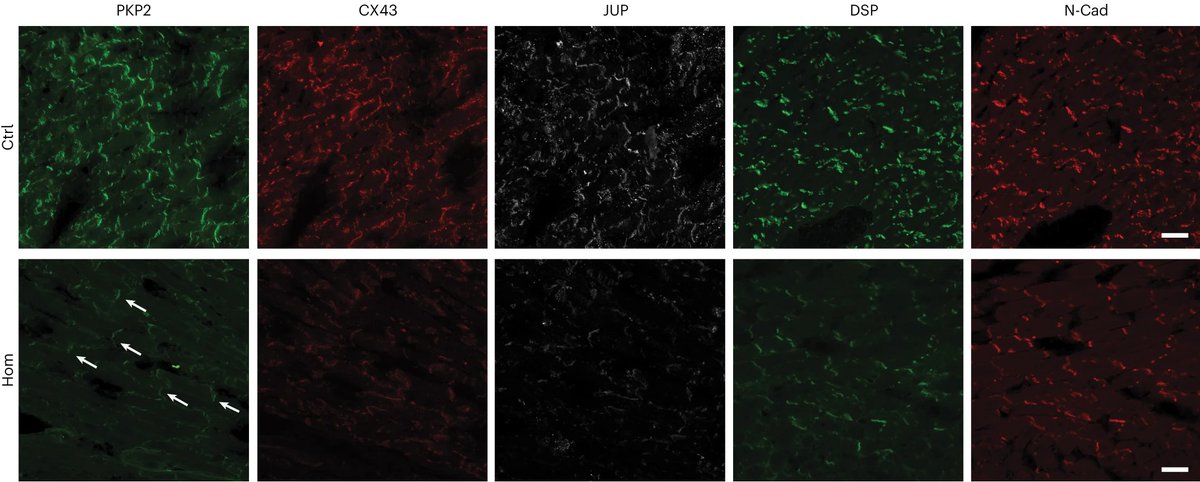 Muscle Cell News (@musclecellnews) on Twitter photo 🔬 Experiments detailed in this study by the <a href="/FarahSheikhLab/">Farah Sheikh</a> suggest that AAV-PKP2 gene therapy holds promise for circumventing ARVC associated with PKP2 mutations, including splice site 📍 mutations.
<a href="/NatureComms/">Nature Communications</a> | go.nature.com/41bmJgK 🔬 Experiments detailed in this study by the <a href="/FarahSheikhLab/">Farah Sheikh</a> suggest that AAV-PKP2 gene therapy holds promise for circumventing ARVC associated with PKP2 mutations, including splice site 📍 mutations.
<a href="/NatureComms/">Nature Communications</a> | go.nature.com/41bmJgK