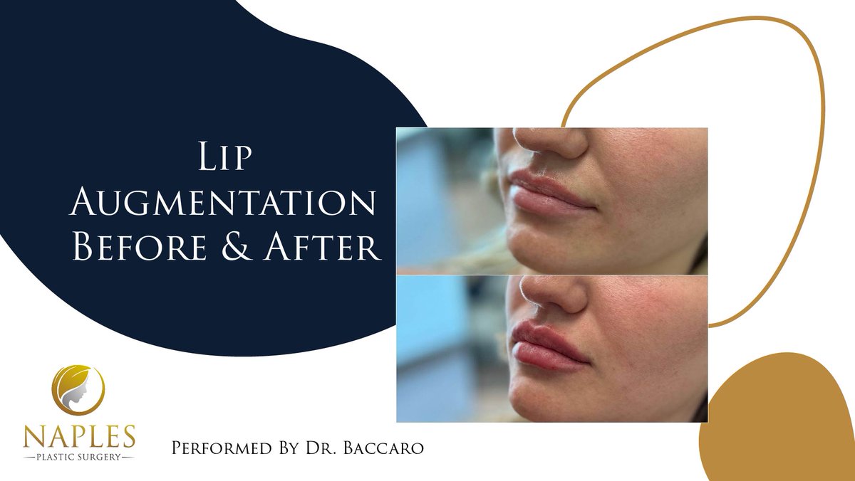 NaplesPlastics's tweet photo. Lip Augmentation Before and After with Dr. Baccaro!👄

Surgical lip augmentation options provide patients with permanent enhancements, including increased fullness, reshaping, and smoothing.✨ https://t.co/eTRWCtOHYT