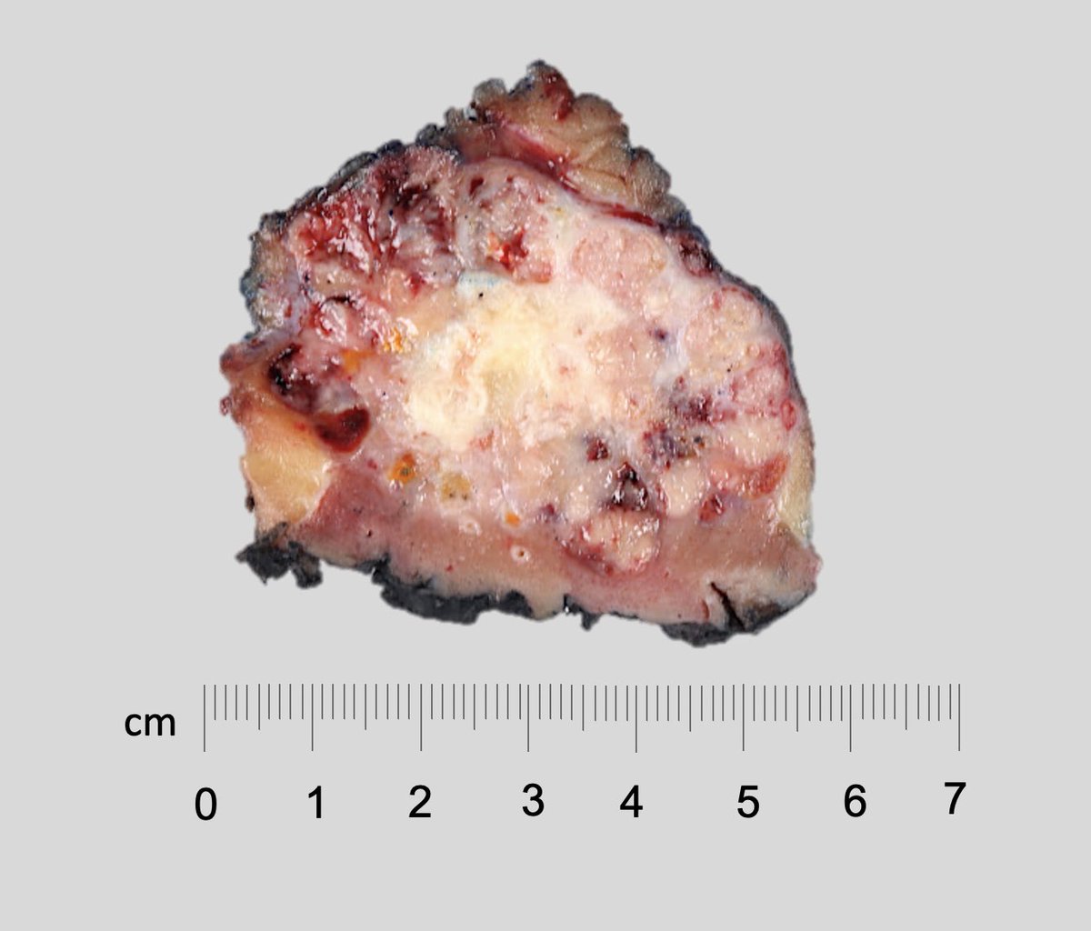 #macrovsmicro partial nephrectomy, variegated red-brown to yellow-tan, focally calcified mass #gupath #pathtwitter #pathoutpic #kidneytumor