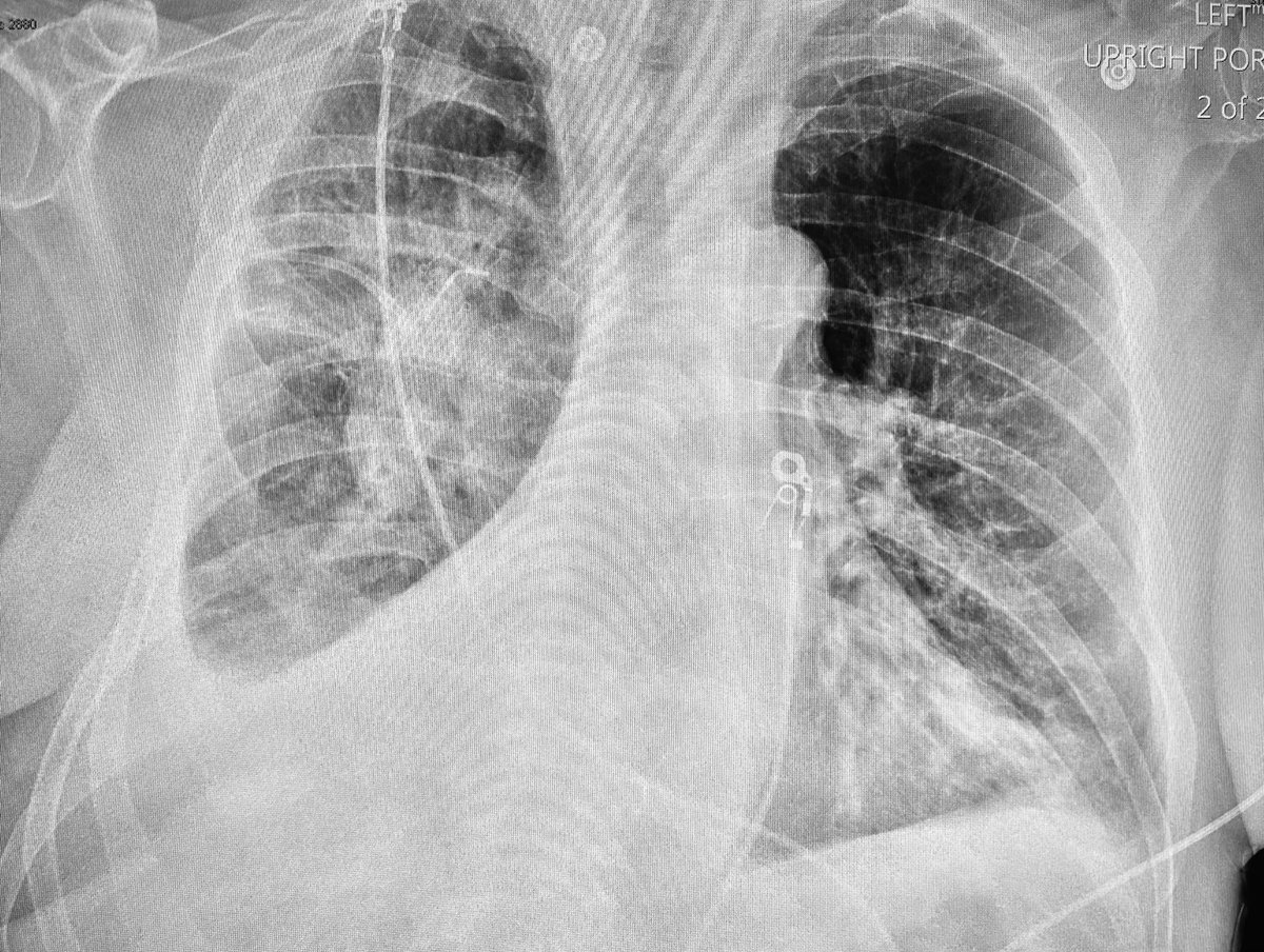 Here’s an important CXR finding that everyone who cares for sick patients ought to recognize. What’s the diagnosis & next step in management? (Quiz on the next slide) 1/