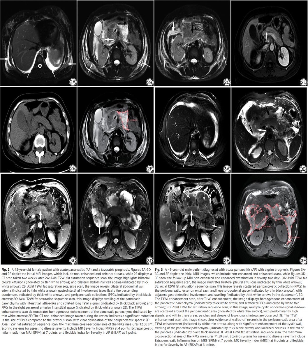 CJMRI_2010's tweet photo. A #nomogram model based on clinical manifestations and #MRI features can effectively predict the early prognosis of peripancreatic collections (#PPCs) in acute pancreatitis (#AP).
https://t.co/ZpS60HuAcx https://t.co/VQUrlFLEpz