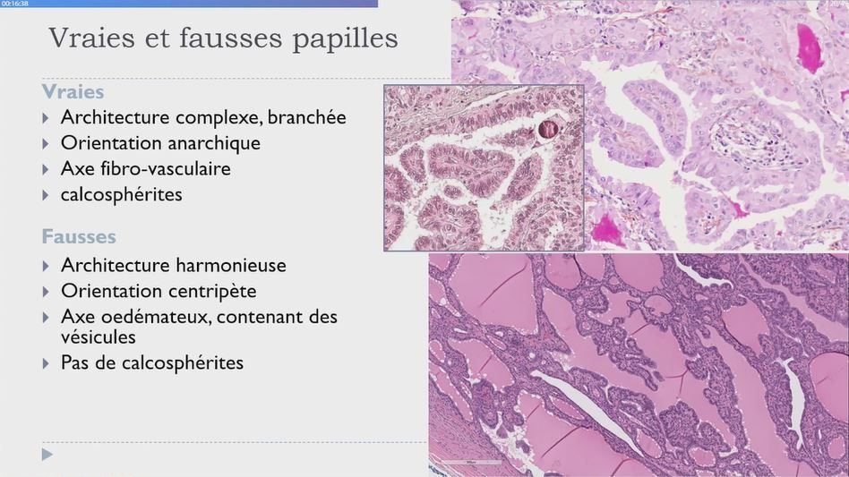 🔬 Tumeurs thyroïdiennes bénignes par Dr Guyetant au #CarrefourPathologie2023 🇲🇫 #pathology #endopath #francophonepath @SFPathol