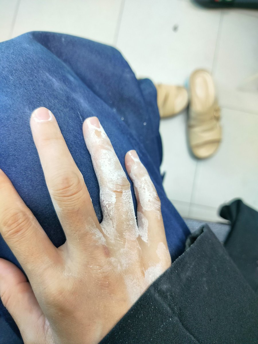 MpAtikah's tweet photo. Baru hujung jari. Belum lagi tempat lain. 
Nak buat keje pun tak boleh.
Mencucuk. Demam. Melepek.
Kulit kena baju pun pedih. Sakit. 
Semoga atikah cepat sembuh. Boleh buat keje macam biasa. Boleh aktif macam biasa. Boleh berkarya kat fabric client macam selalunya https://t.co/hTC0cbkirO