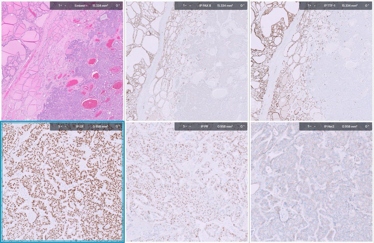 Thyroid mass .. one missing IHC what is it? What is ur dx ? #PathTwitter #pathology #pathologyfamily #surgpath