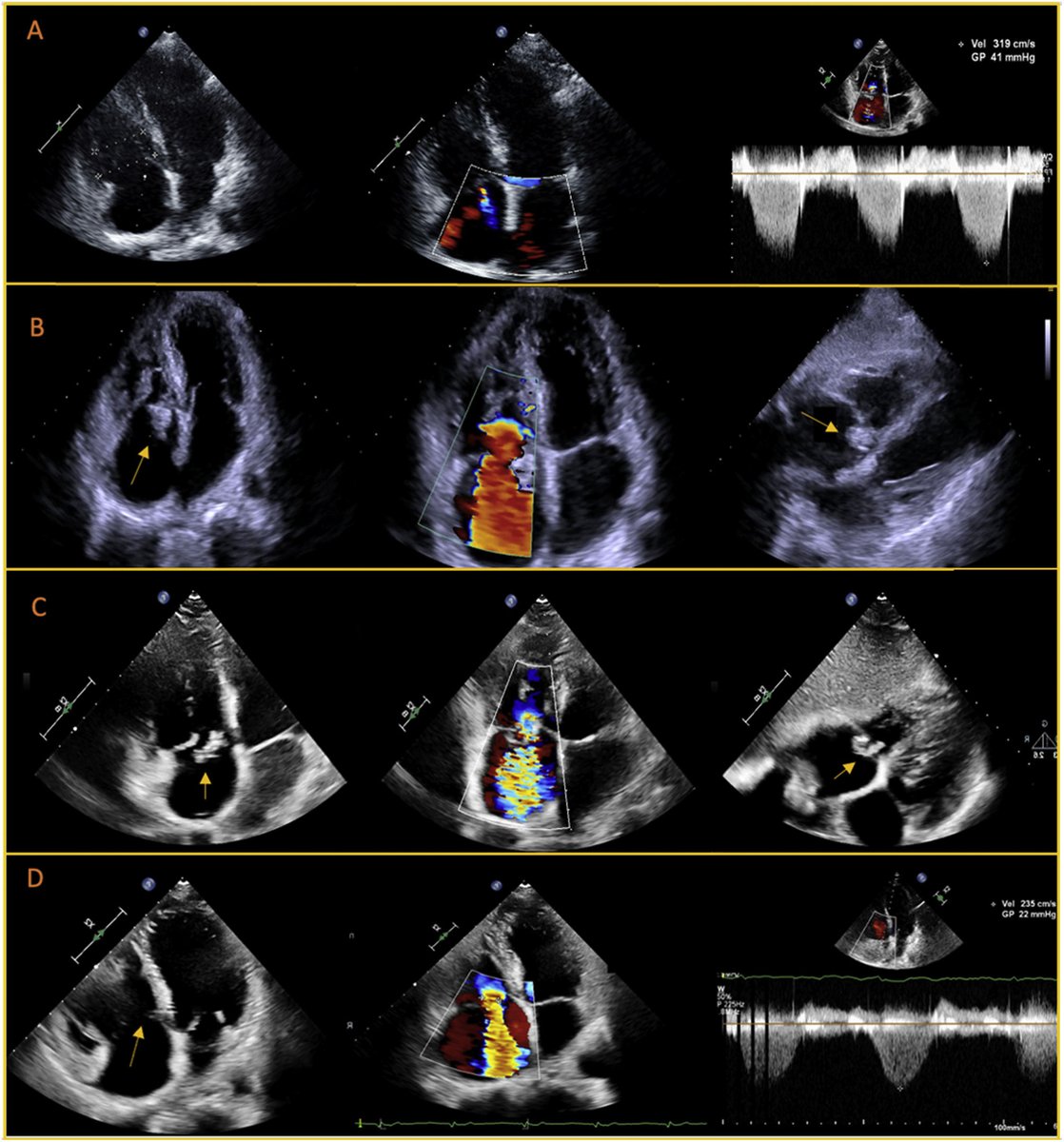 REC Publications (@revespcardiol) on Twitter photo Middle-aged woman with congestive symptoms: more than just pulmonary arterial hypertension #REC <a href="/NachoGalloFer/">Ignacio Gallo</a> <a href="/PereaJorge5/">Jorge Perea</a> <a href="/danielpwulf/">Daniel Pastor Wulf</a> <a href="/JosueBaizan/">Josué López Baizán</a> revespcardiol.org//en-middle-age… Middle-aged woman with congestive symptoms: more than just pulmonary arterial hypertension #REC <a href="/NachoGalloFer/">Ignacio Gallo</a> <a href="/PereaJorge5/">Jorge Perea</a> <a href="/danielpwulf/">Daniel Pastor Wulf</a> <a href="/JosueBaizan/">Josué López Baizán</a> revespcardiol.org//en-middle-age…