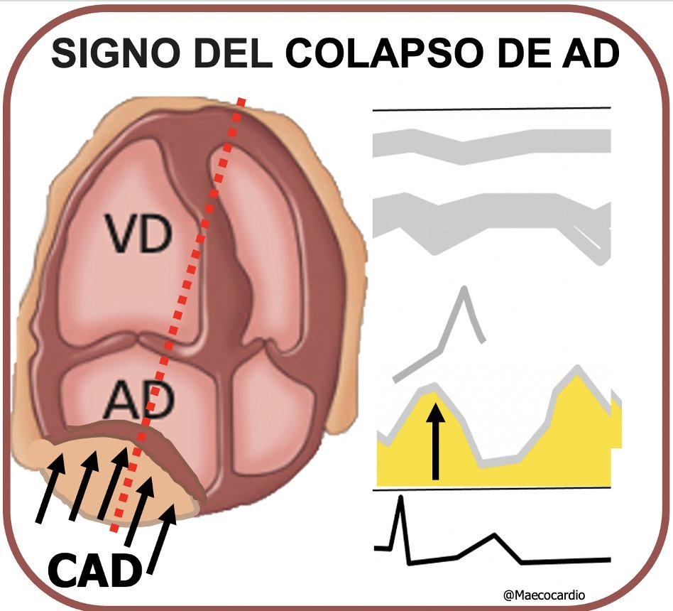 MAecocardio's tweet photo. SIGNOS ECOCARDIOGRAFICOS #EcoSignos 
📢Signo del colapso sistólico de AD: Presente en taponamiento cardiaco.
 📌Especificidad 95% ;Sensibilidad 70 % (⚠️)
📌 Inicialmente durante la espiración.
 📌La duración es indicador de la gravedad. https://t.co/VWgzfKaK2e