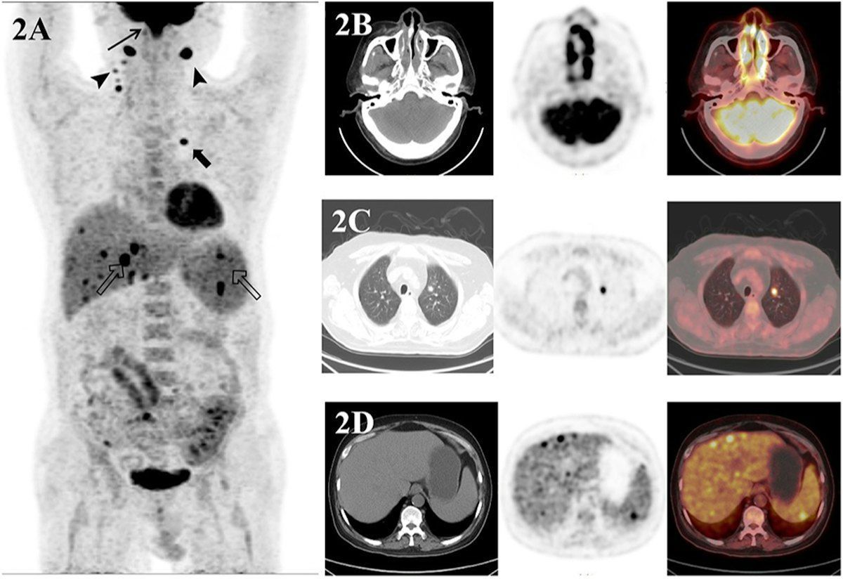 PET/CT scans ‘crucial’ in patients with NK/T-cell lymphoma #radiology #lymphoma bit.ly/3TBmQjT