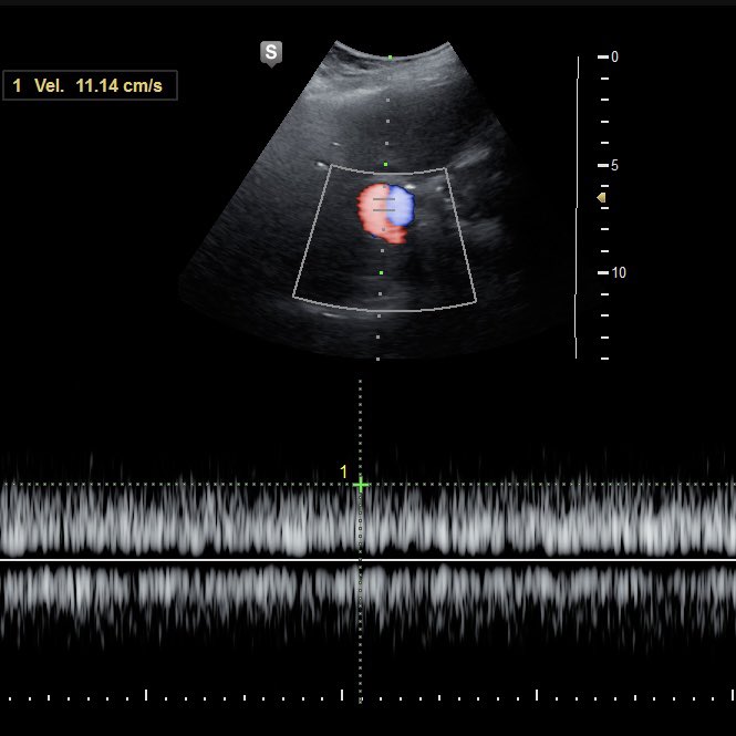 70y F👩‍🦳 with history of cirrhosis, choledocholithiasis,cholecystectomy and multiple ERCPs.

Diagnosis?