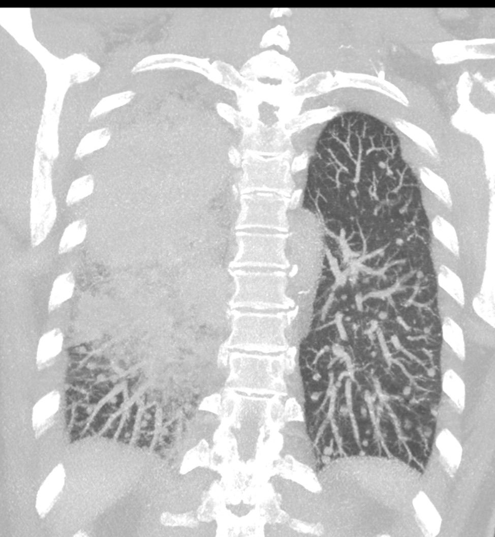 An unusual cause of extensive lung consolidation. This was biopsy-proven adenocarcinoma with bilateral hematogenous metastases.

#radres #radiology #FOAMrad #chestrad