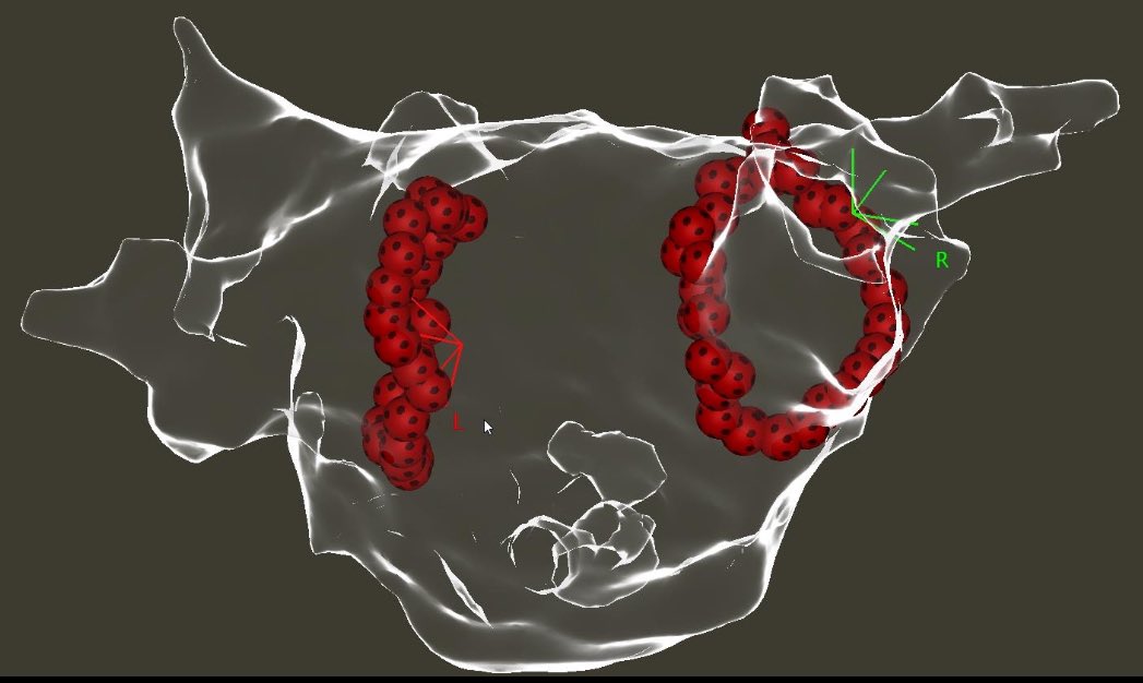 Ben Wiles (@benwilesep) on Twitter photo Did a series of 90W left atrial ablation cases this week using QDot - the first time this technology has been used in Scotland. Love the little footballs and, appropriate for the time of year, I think this picture looks a bit like a reindeer! Did a series of 90W left atrial ablation cases this week using QDot - the first time this technology has been used in Scotland. Love the little footballs and, appropriate for the time of year, I think this picture looks a bit like a reindeer!