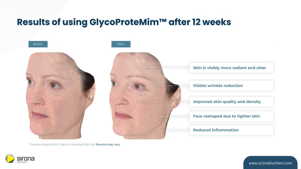 Real Results in 12 Weeks. From reduced wrinkles to reshaped contours, see the visible impact of GlycoProteMim™ on aging skin.

#GlycoProteMim #TFC1326 #AntiAgingInnovation #ClinicalTrialResults #TwoWeeksresult #BeforeAndAfter #AgeDefying #BeautyScience #AntiWrinkleTechnology