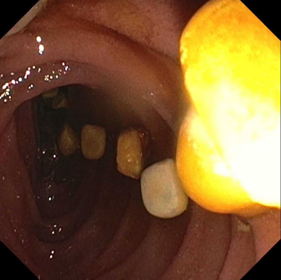 A veritable conga line of stones! 🕺💃🕺🪨🪨🪨

Nothing like good duct clearance 🧹
#GITwitter #ERCP #FlowerBasket