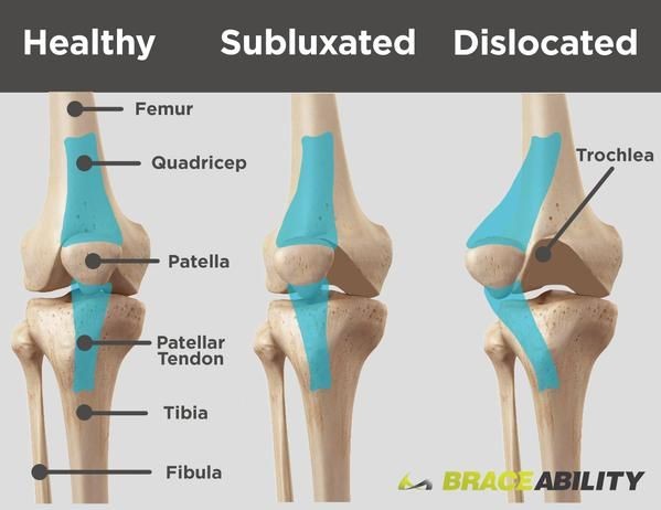 Dr. OMID BANDARCHI on X: Patellar subluxation, a patellar tracking  disorder, occurs when your patella (kneecap) becomes partially dislocated.  Normally, a subluxed patella will return to its normal position by itself.  Repeated