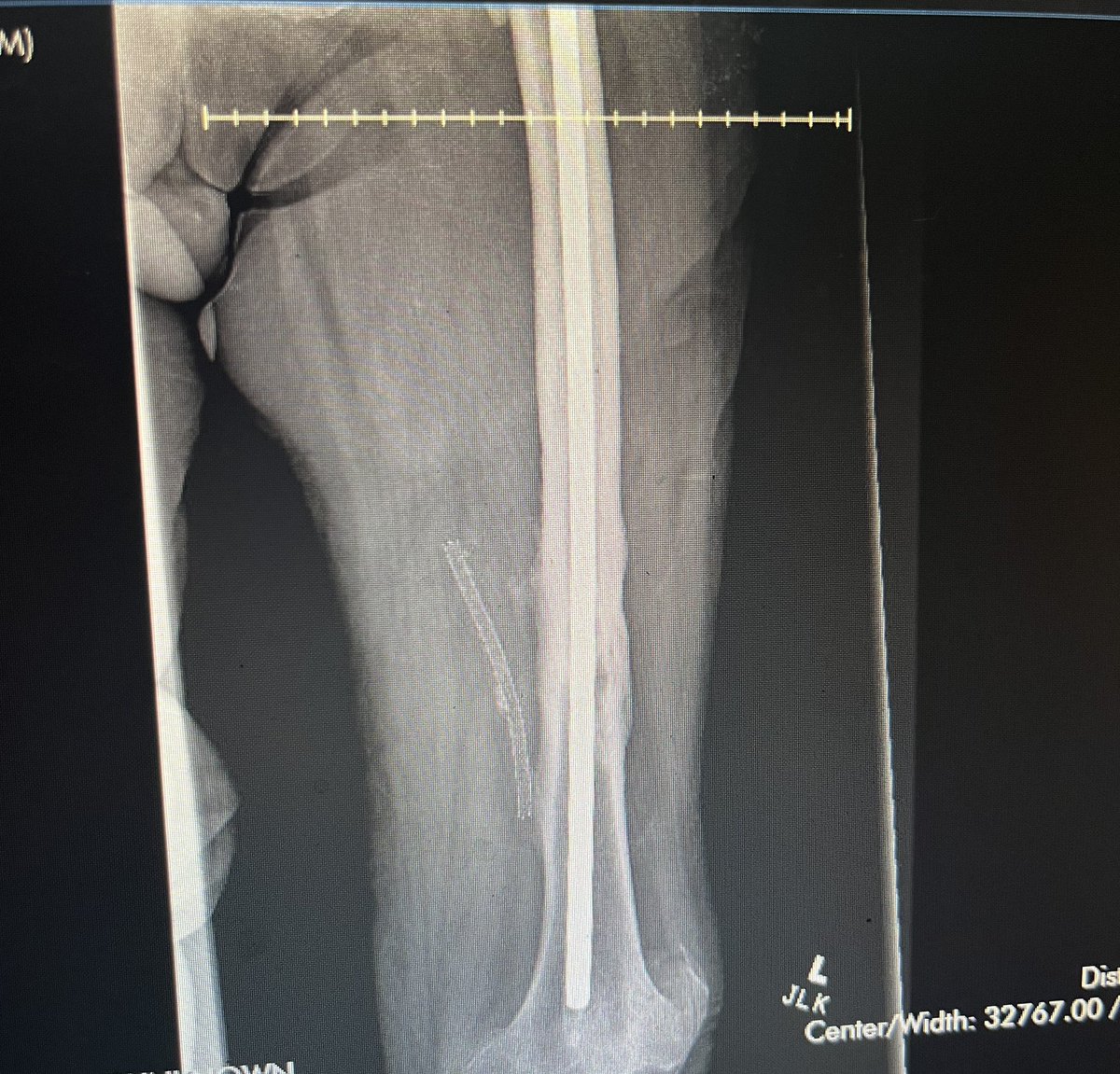 I guess Santa has me on the naughty list this year….This nail has been in way longer than I’ve been alive. #orthotwitter