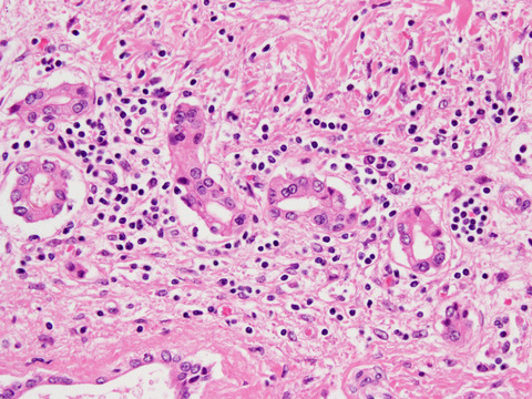 TAFRO syndrome is defined by the presence of thrombocytopenia, anasarca, fever, reticulin fibrosis/renal dysfunction.
#TAFROsyndrome #hypercytokinemia #organomegaly #interleukins #idiopathy #allergicreactions #pathophysiology #Castlemandisease #patients #diagnosis #covid19 #fever