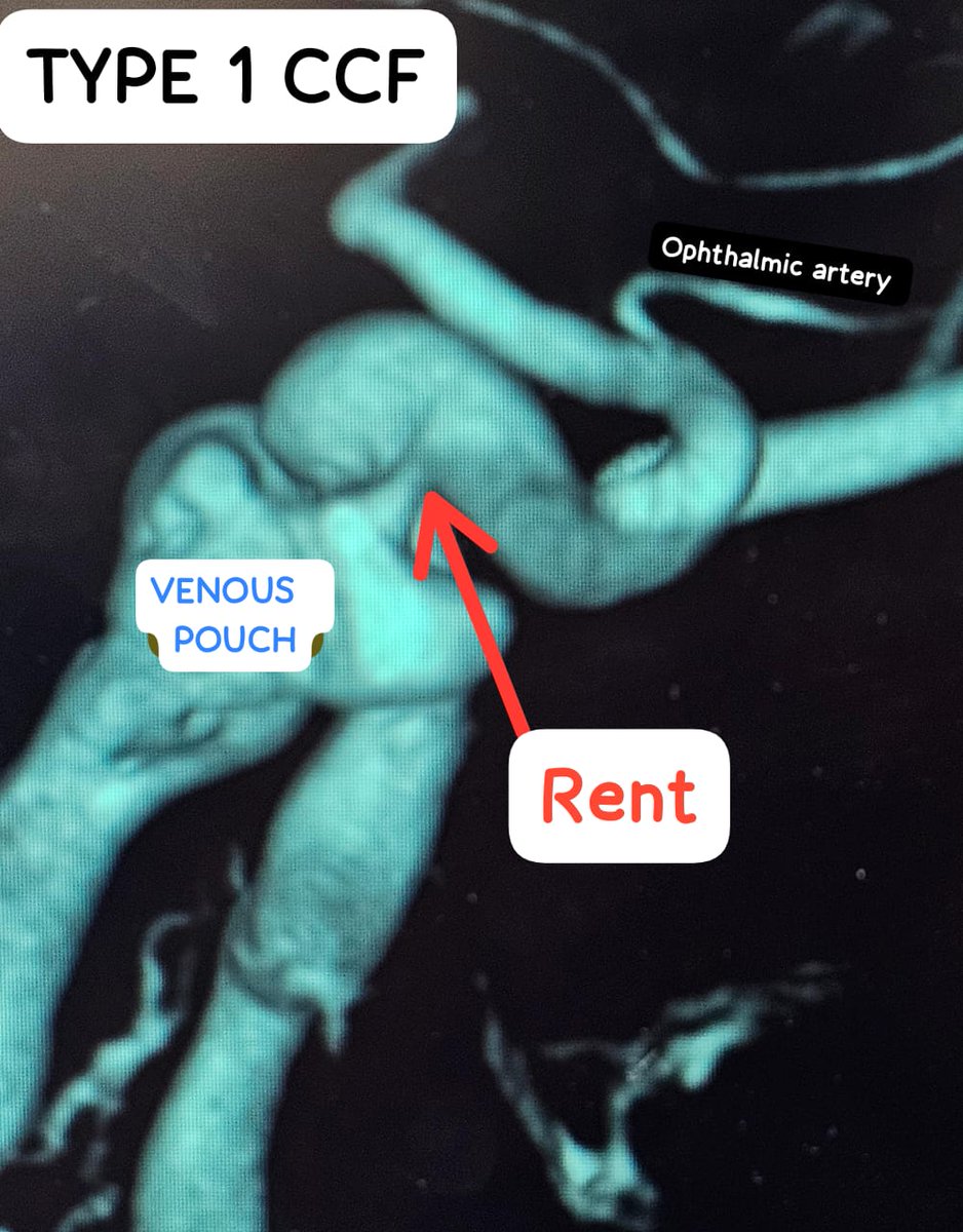 SharathKumarGG7's tweet image. Type1 caroticocavernous fistula [CCF] treated with transarterial coils (2) &amp;amp; Onyx (1) successfully! 3D helps in procedure planning &amp;amp; execution especially in localising the rent.
#fístula #CCF #headinjury #endovascular #coiling #embolization #neuroscience #InterventionalRadiology