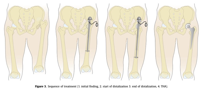 Is subctroch osteotomy the only option for Crowe IV dysplasia? This paper describes using an IM nail w/ pelvic support plate to gradually stretch hip soft tissue, & eventual THA in the native hip center. #orthotwitter @hugortopedista @theartfu1doctor arthroplastytoday.org/article/S2352-…